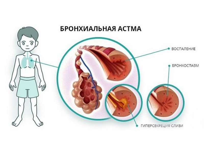 Bronchial asthma. Бронхиальная астма. Бронхиальная астма картинки. Аллергическая бронхиальная астма. Симптомы астмы картинки.