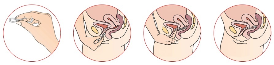 Кольцо контрацепция